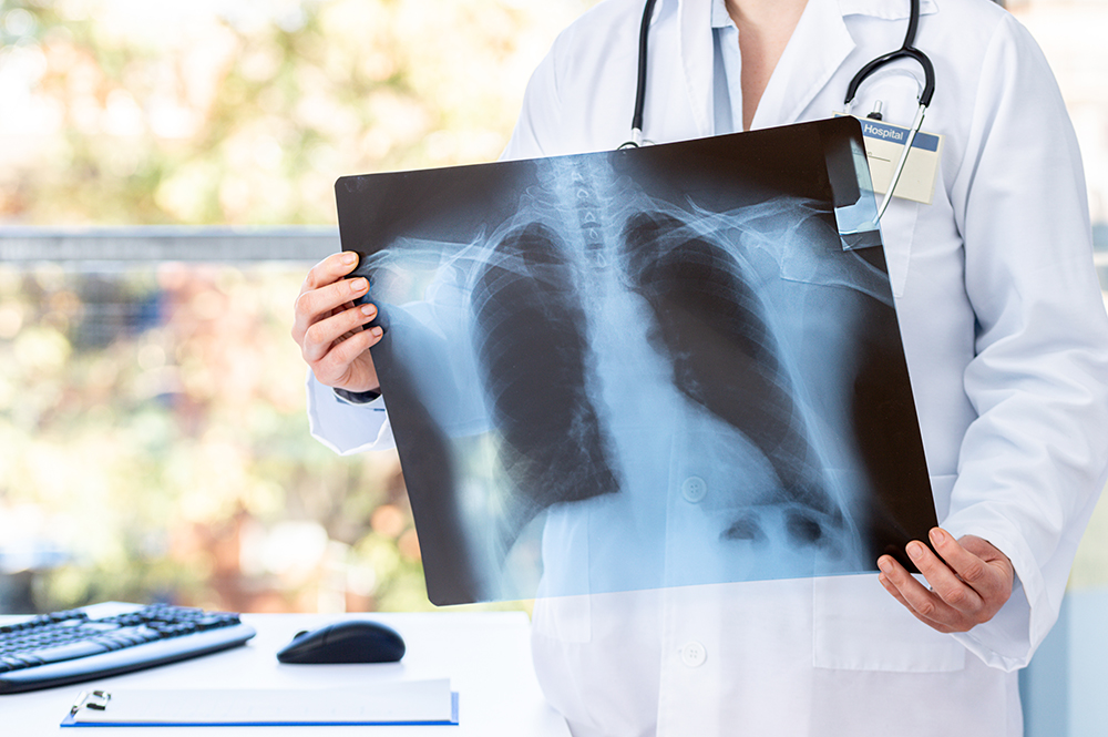 iStock photography/Cunaplus_M.Faba/chest X-ray of patient with long-haul covid